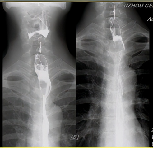 不可切除肺癌肿瘤治疗方法,不可切除晚期治疗什么意思