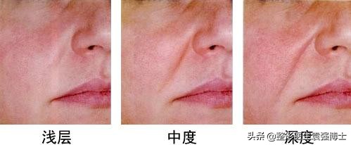 这3种方法解决法令纹效果很惊艳,这3个方法帮你去除法令纹