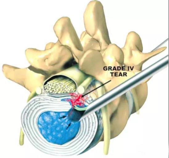 慢性疼痛药物治疗新进展,干细胞疗法治疗慢性疼痛