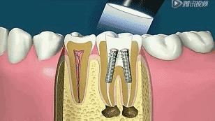 根管治疗后期症状,根管治疗全过程真的很痛吗