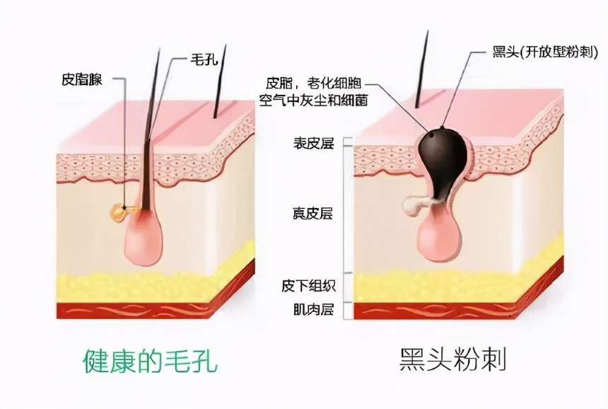 药店去黑头的6种药膏国货,用手挤黑头的护肤品