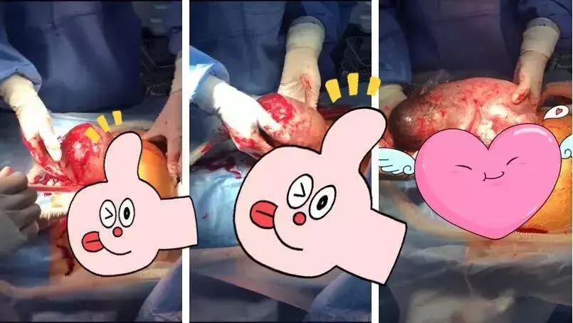 裹着没破的胎膜出生的婴儿,早产儿出生最紧要的措施