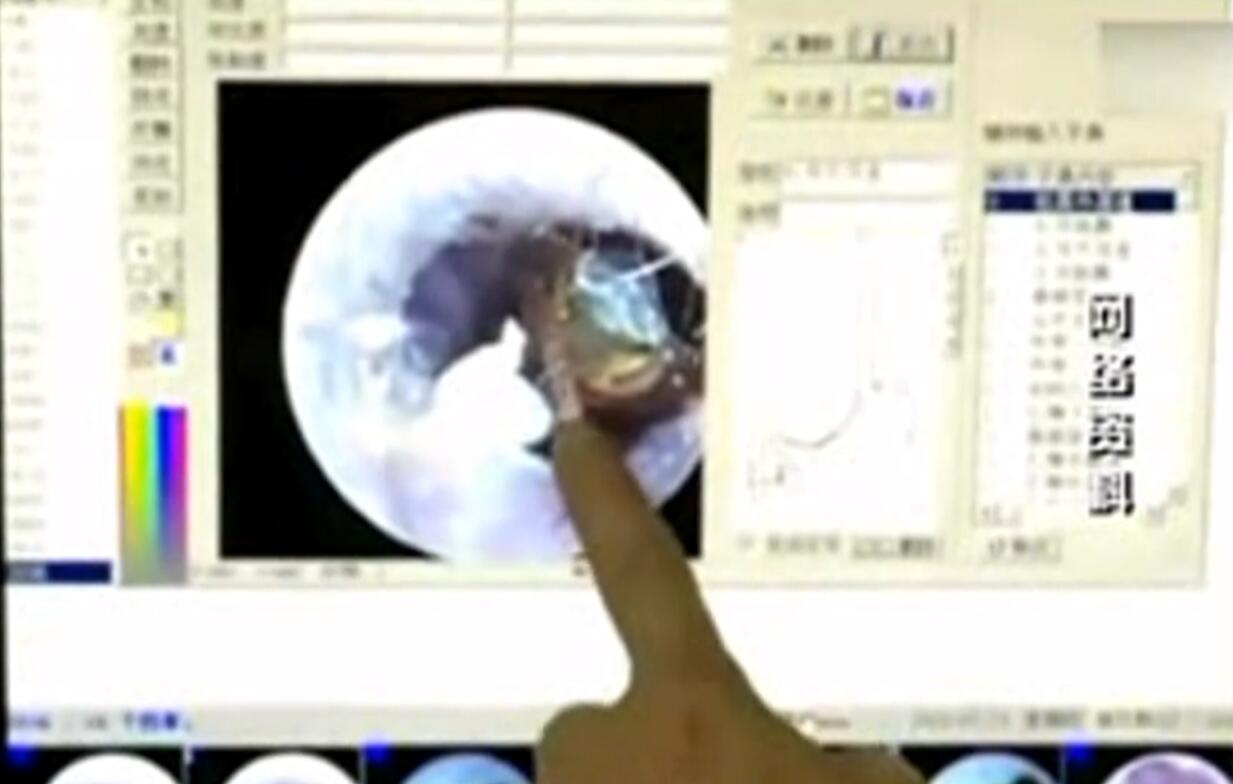 蟑螂钻进小男孩的耳朵里,蟑螂钻进耳朵产下25个小蟑螂