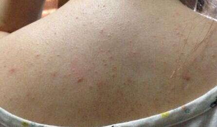 后背长痘痘的原因和解决方法图文,后背长痘痘如何正确有效解决