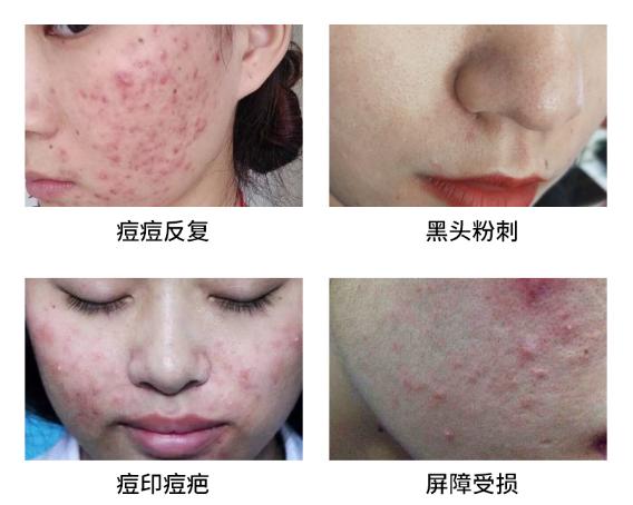 清痘润颜修复凝胶效果怎么样,xdg清颜修护凝胶