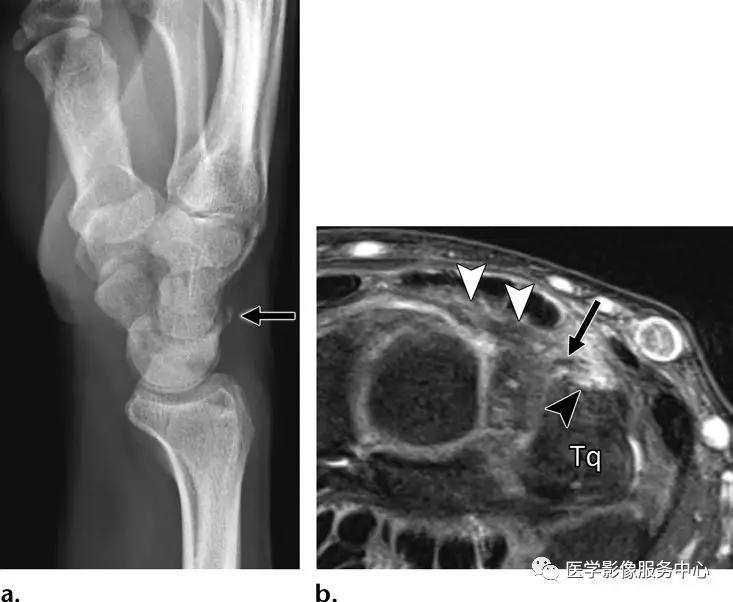 手腕撕脱性骨折一年了还隐隐作痛,手腕三角骨撕脱骨折症状有哪些