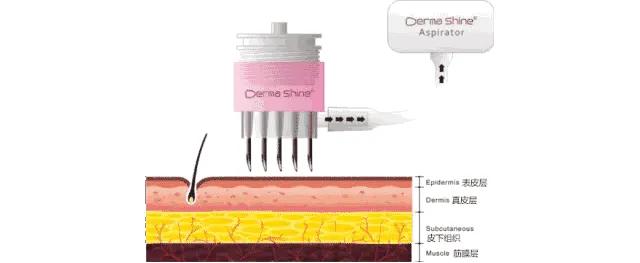 注射水光针为什么皮肤油亮,注射水光后皮肤干