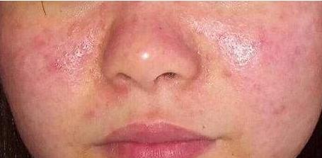 面部已经卡粉起皮超级严重怎么办,面部油黑怎么解决