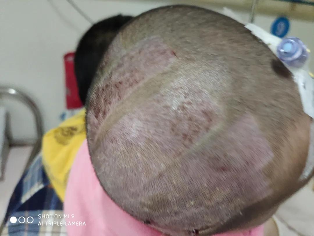 烫伤后及时清创能促进伤口愈合吗,深度烫伤后多久植皮比较好