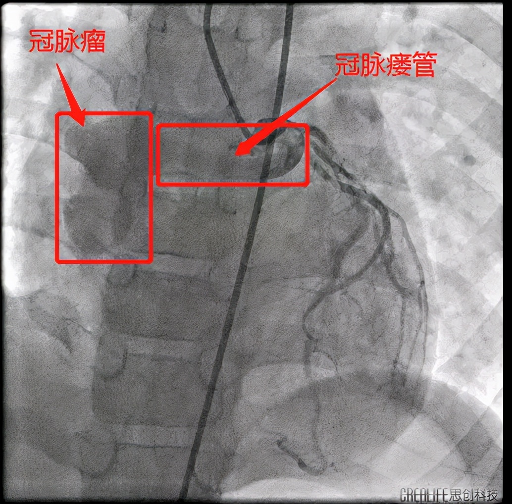 婴儿冠状动脉瘘微创手术,先天性冠状动脉瘘手术成功率