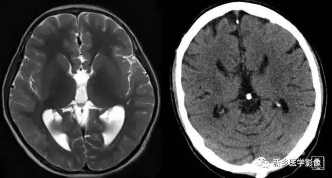什么引起成人脑室扩大,哪些病可以导致左侧脑室增宽