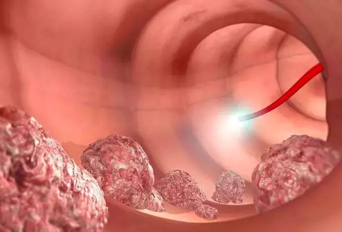 肛肠科常见便血性疾病的鉴别,偶尔便血是痔疮吗