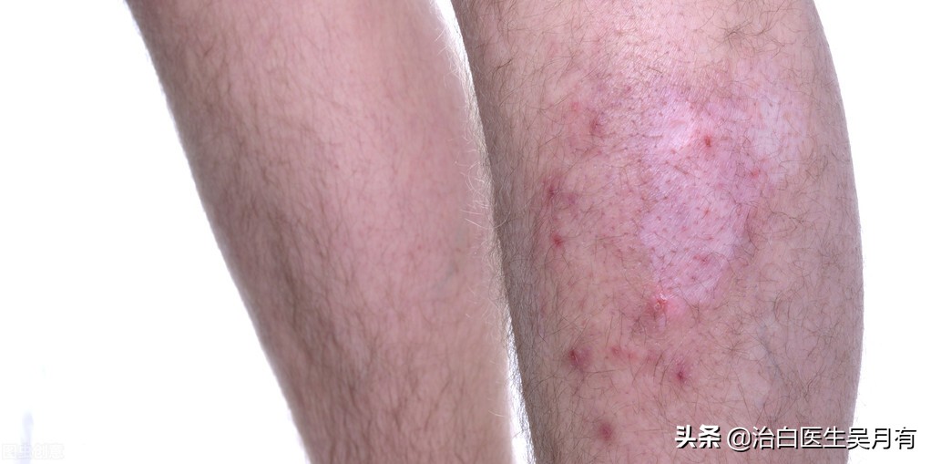 白癜风308光疗做完多久能做头发,白癜风308光疗剂量最多加到多少