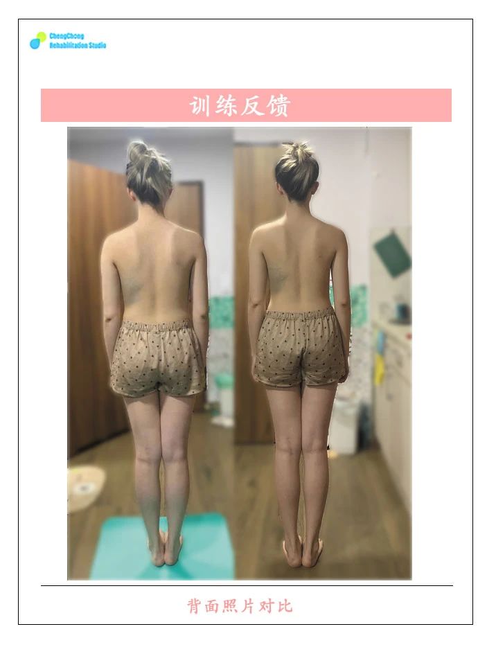 左脸右脸不像同一个人,左右脸很明显的不对称怎么改善