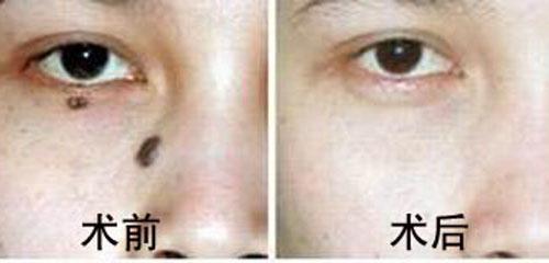 华亦俏朱红博士说：祛痣应该注意什么？