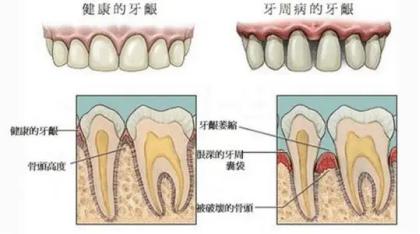 牙签会把牙缝越剔越大,经常剔牙会使牙缝越剔越大吗