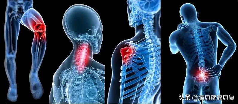 理疗对骨性关节炎有什么作用,骨性关节炎炎症怎么消除