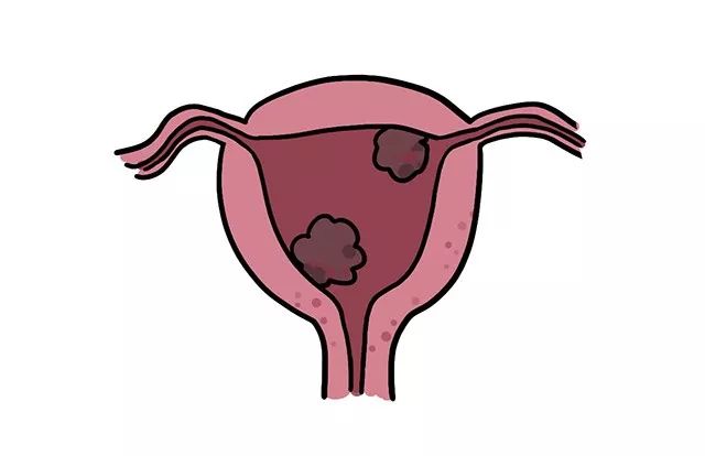 25岁没男友，未婚未孕，却得了很大的子宫肌瘤？