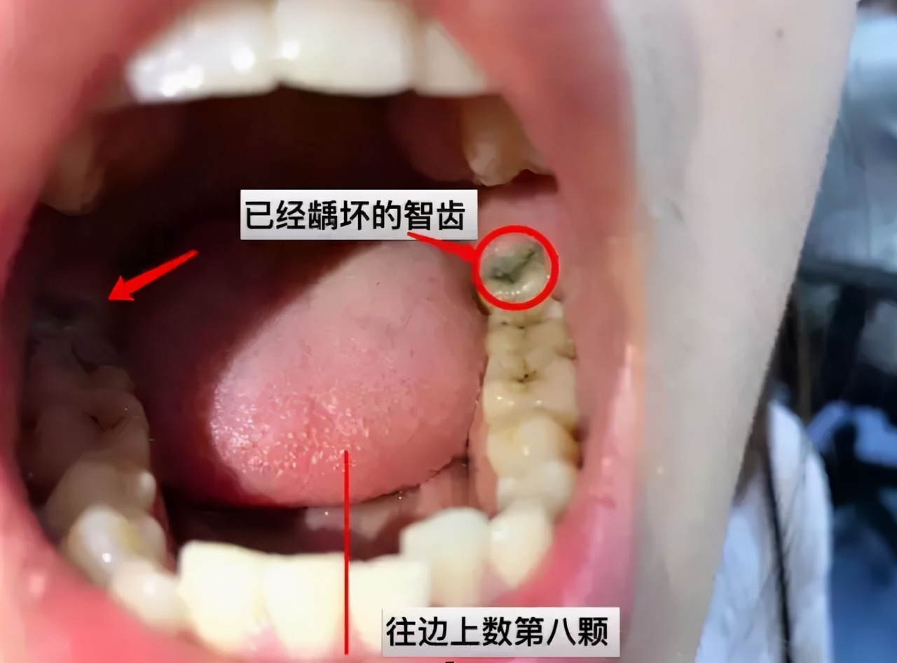 有没有智齿不拔的案例,我有个智齿没长出来怎么拔