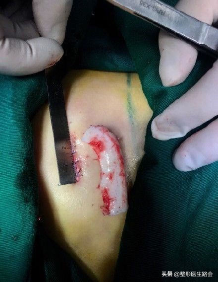 想去隆鼻,隆鼻到底值不值得入手