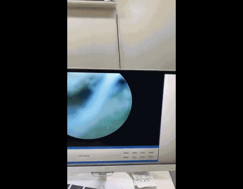 类风湿吃药导致四肢无力怎么办,类风湿吃纷乐多久可以缓解疼痛