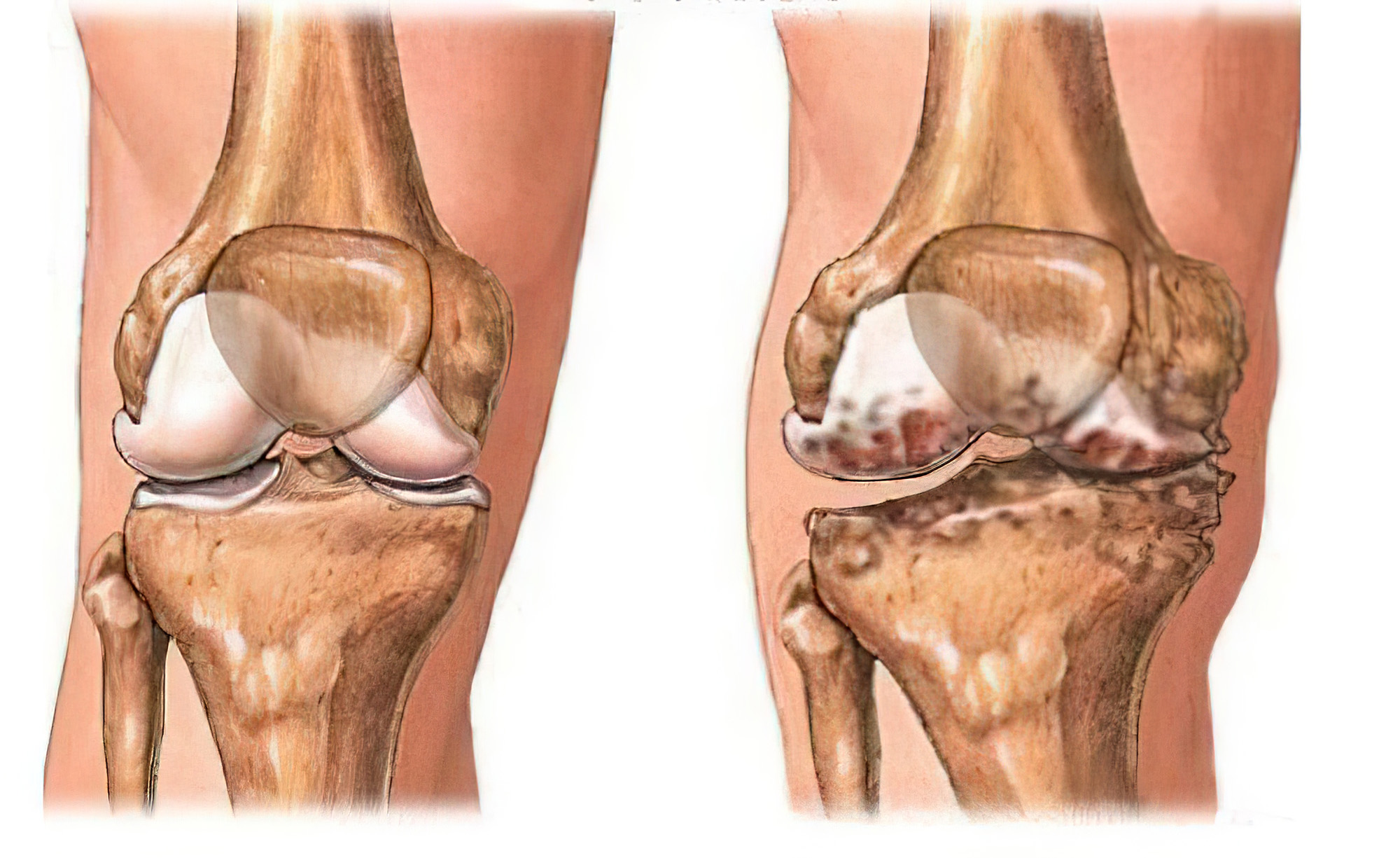打封闭止痛快？去骨刺不再痛？骨关节炎患者止痛需避开四大陷阱