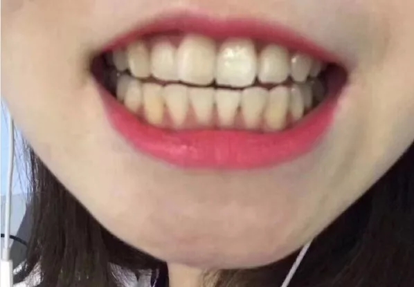 刘涛是全口瓷牙,演员刘涛的一口烤瓷牙多少钱