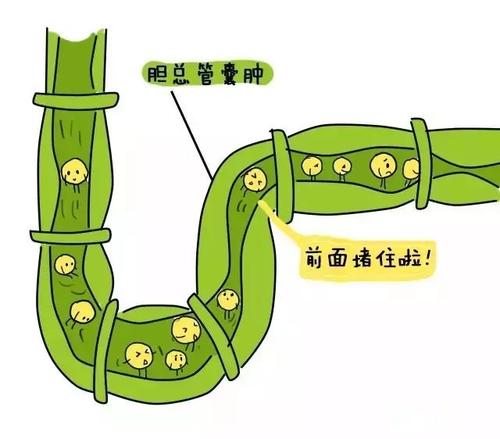 出现黄疸是不是一定得了肺炎,出现黄疸就一定是胆管癌吗