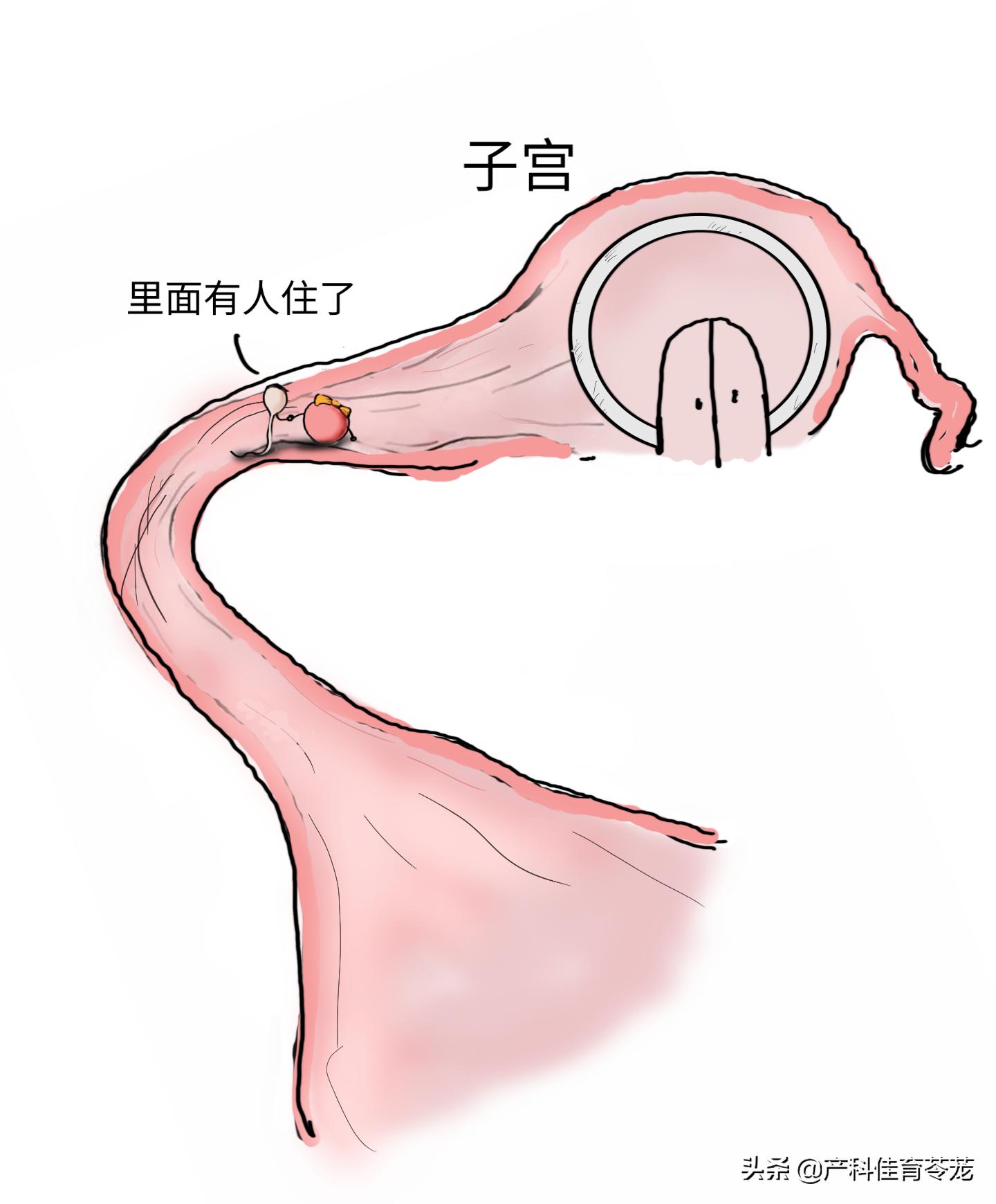 好怕输卵管堵塞怎么办,排卵后输卵管隐隐痛怕宫外孕