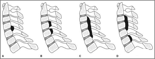 检查发现颈椎错位怎么办,后纵韧带骨化是脊髓型颈椎病吗