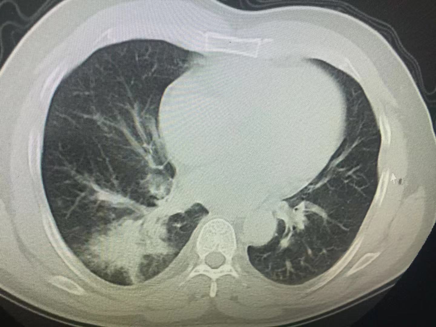 只是咳嗽要去医院做什么检查,感冒咳嗽需要拍胸片吗