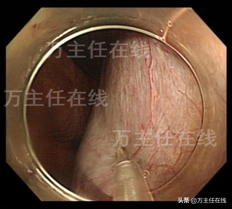 消化内科肝脏手术,肝部囊肿切除手术