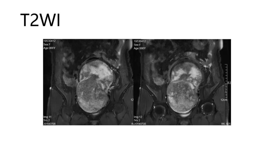 卵巢原发肿瘤的分析思路