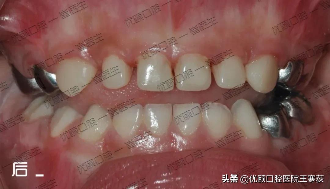 儿童全麻治疗过程,三岁宝宝根管治疗全麻有危害吗