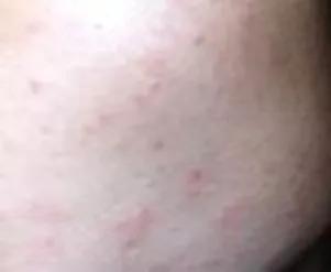 改善暗沉闭口粉刺敏感肌的水乳,如何拯救烂脸痘痘肌