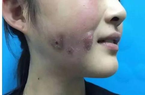 医美最火的项目,哪些皮肤类医美项目不建议做