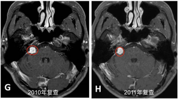 听神经瘤复发做二次手术,听神经瘤复发能要命吗