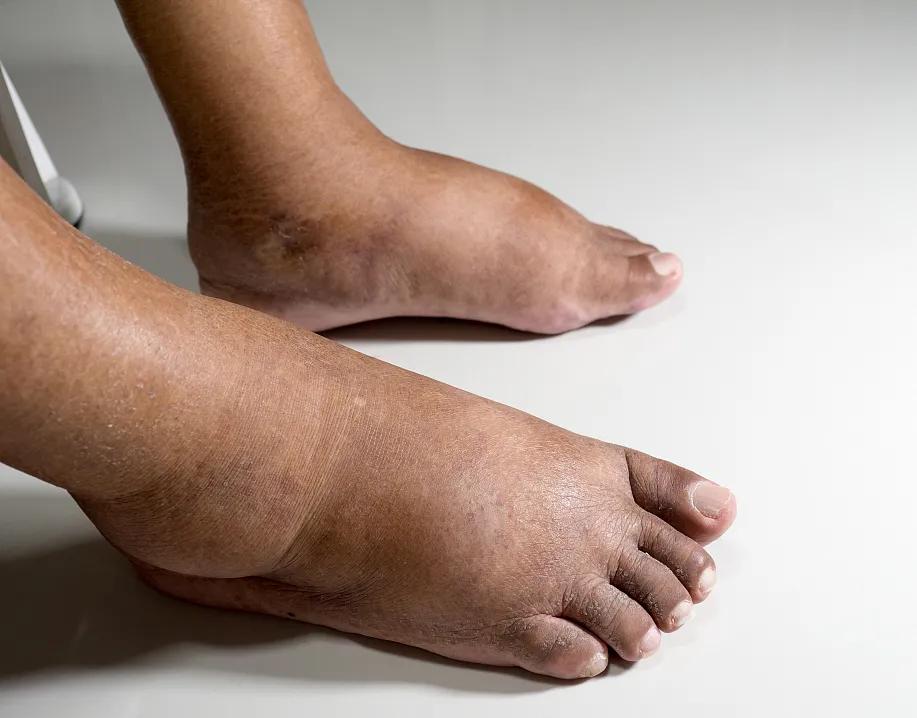 糖尿病一定是尿微量白蛋白升高吗,糖尿病就是尿多吗