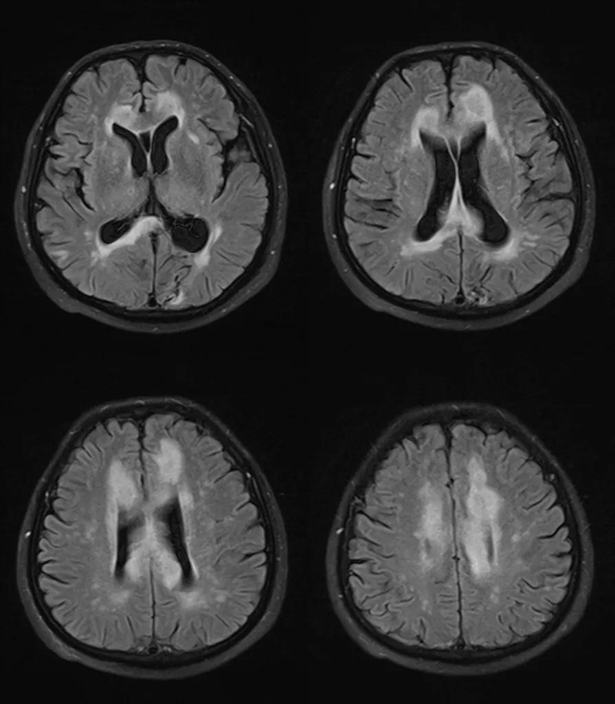 胼胝体有什么症状,胼胝体形态较小可以治疗吗
