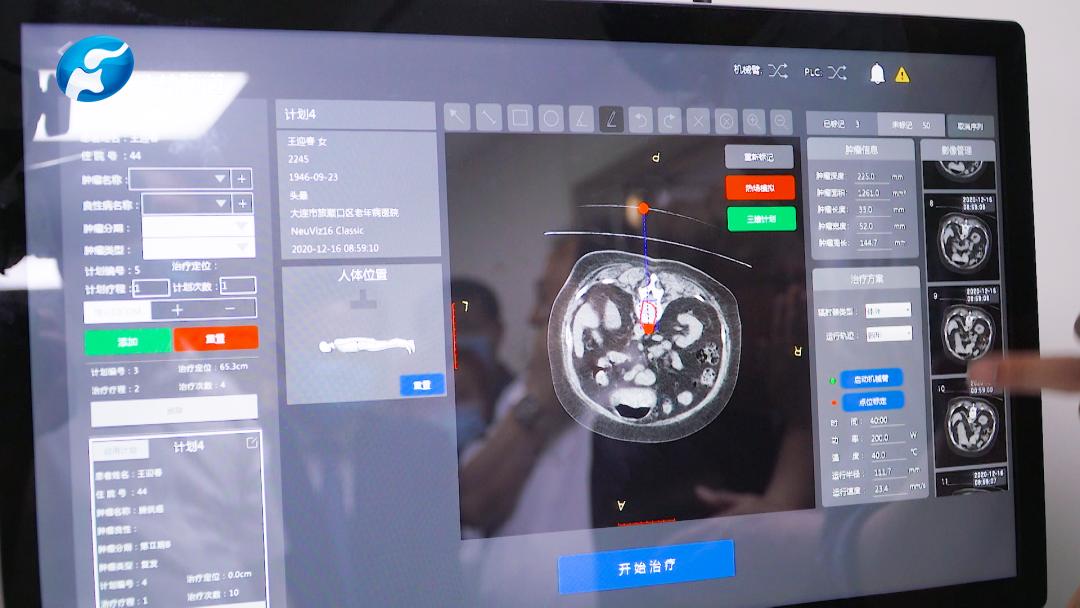肿瘤绿色疗法有用吗,肿瘤热疗郑大一附院南区