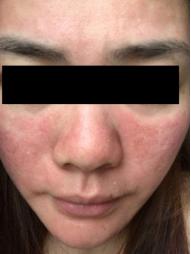 激素脸是怎么形成的,激素脸是怎么引起的呢