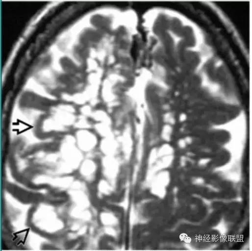 各种囊肿的症状,颅内囊肿18-19mm严重吗