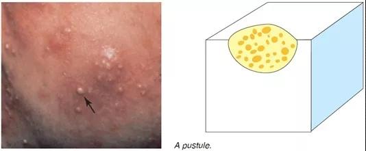 痘痘为什么越来越多如何正确祛痘,祛痘痘的效果是长痘痘还是消痘痘