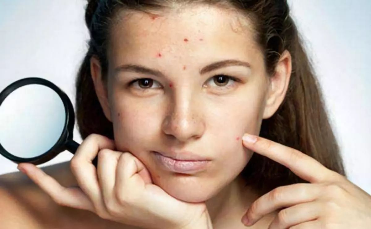 痘印痘坑疤痕用啥治疗效果好,安阳哪家医院治疗痘坑效果好