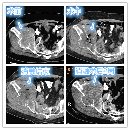骨盆肿瘤手术做不了了怎么办,骨盆转移瘤