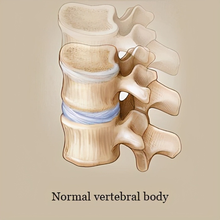 骨密度测试25岁骨质疏松,做ct有骨质疏松还需要测骨密度吗