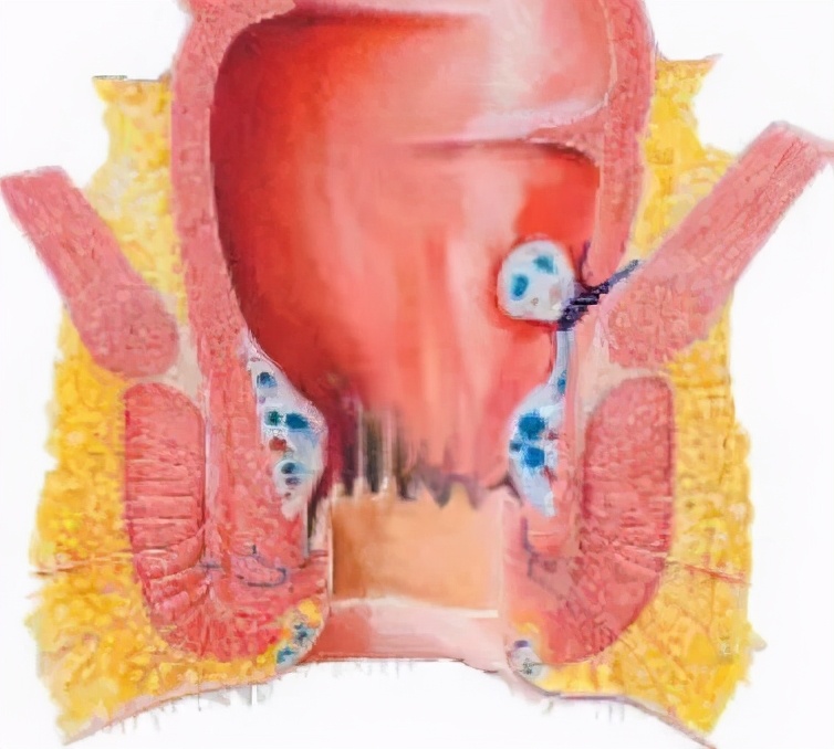 痔疮手术出院后可以不复查吗,痔疮手术后不排便可以出院吗