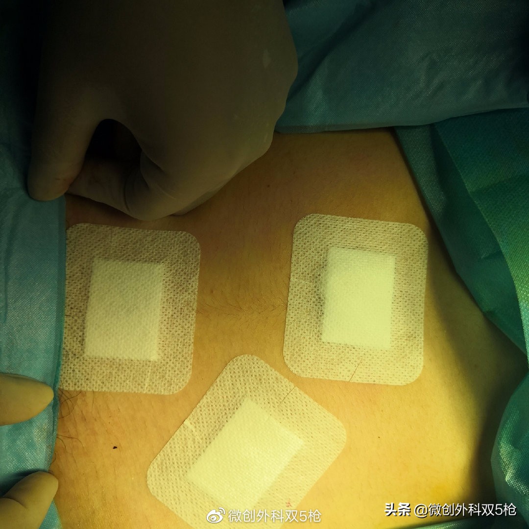 阑尾炎症状是什么部位痛,阑尾炎是什么样的疼