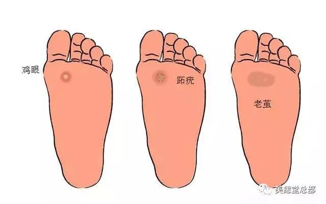鸡眼跖疣肉刺三者之间有什么区别,跖疣鸡眼和胼胝的区别