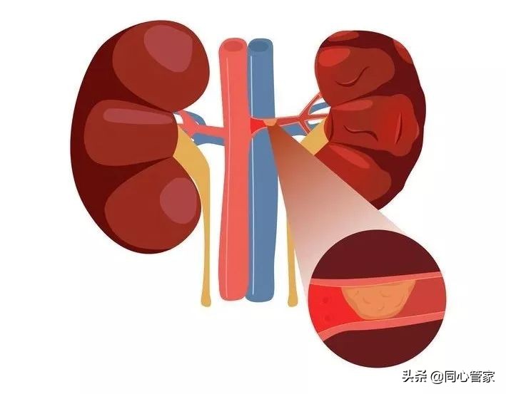 血管狭窄如何扼住生命的咽喉？让你全身器官都遭殃